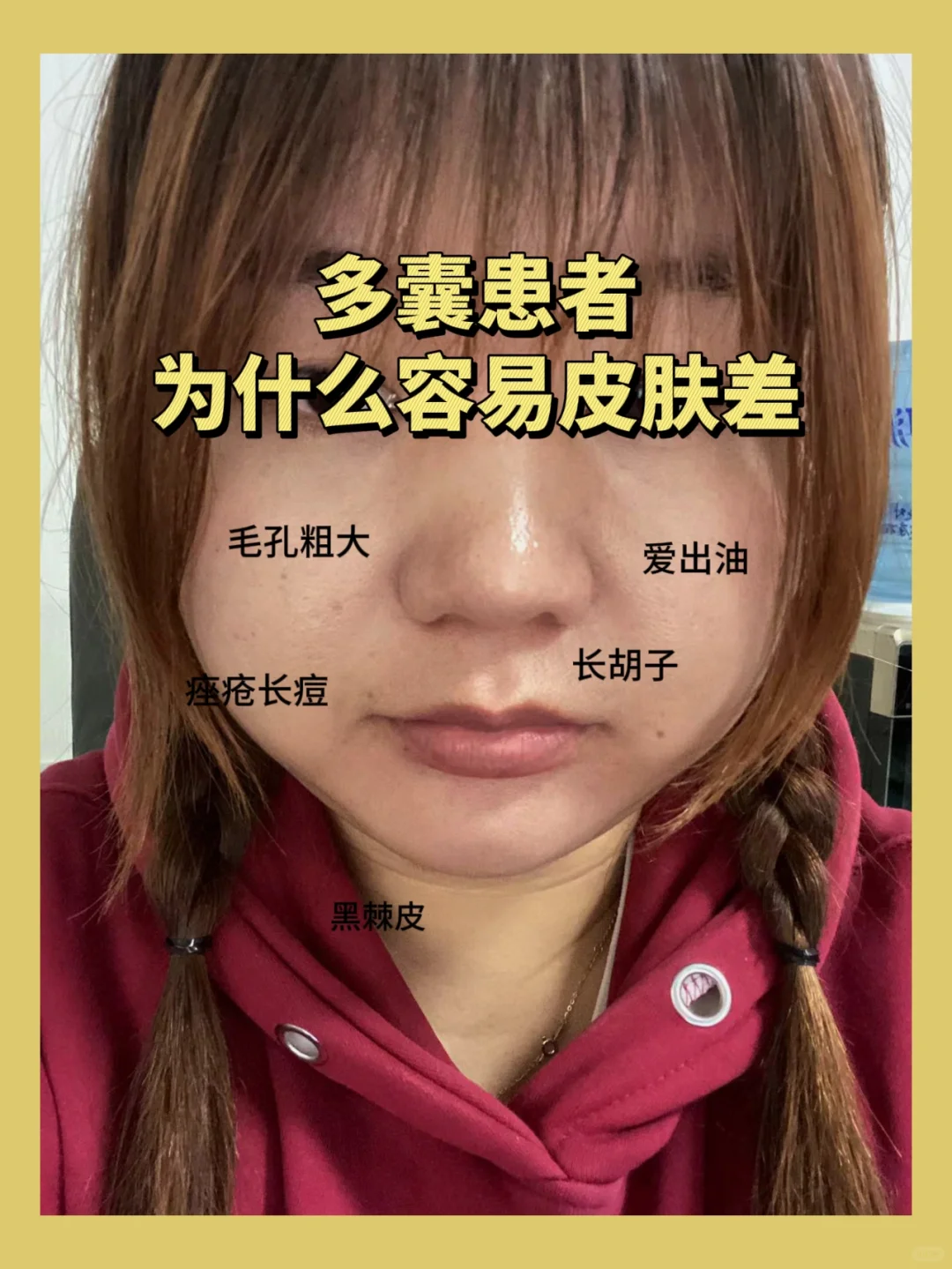 多囊患者为什么容易皮肤差？,哪里做代孕最好